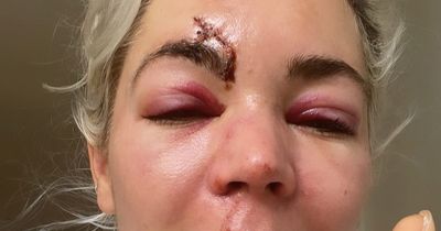 A Place in the Sun presenter Danni Menzies shares pictures of injuries after horror moped crash