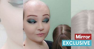 Young woman with hair-pulling disorder dreams of having a 'full head of hair'