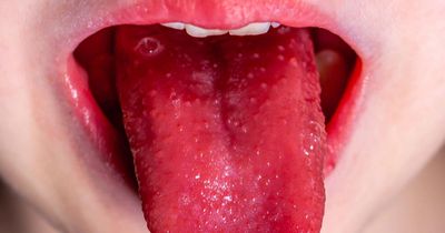 Strep A boost as no new cases recorded in Greater Manchester last week