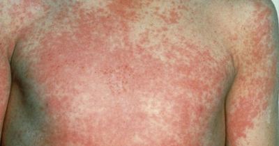 Scarlet fever symptoms as Strep A bacteria 'still circulating at high levels'
