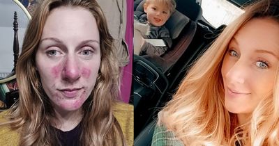 Mums blown away by £8 'miracle in a jar' that cures painful eczema and dry skin 'overnight'