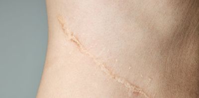 How to treat scars at home – and hopefully make them disappear