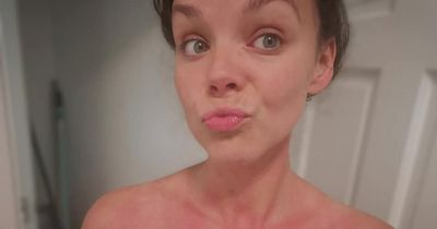 'I've been made fun of my whole life' Woman allergic to cold told she looks like a ‘monster’ because of red and blotchy skin