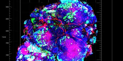 Stopping the cancer cells that thrive on chemotherapy – research into how pancreatic tumors adapt to stress could lead to a new treatment approach