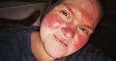 Woman was branded a 'tomato' by cruel bullies because of skin condition