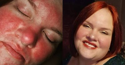 Woman branded a 'tomato' by bullies because of skin condition finds miracle cure