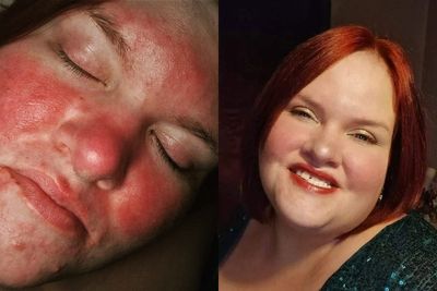 Woman dubbed a ‘tomato’ because of ‘misunderstood’ skin condition