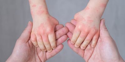 Cold weather brings itchy, irritated, dry and scaly skin – here's how to treat eczema and other skin conditions and when to see a doctor