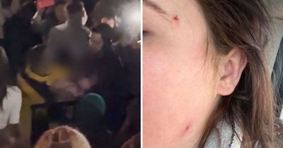 Mum left with bald patches after 'drunk woman' hurled abuse and ripped out her hair in attack that halted Lewis Capaldi gig