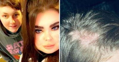 Mum left with bald patches after 'drunk woman' ripped out hair at Lewis Capaldi gig