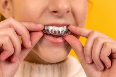 DIY dentistry warning: Dentists warn of online aligners and TikTok trends