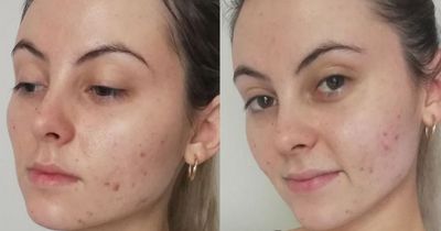 Beauty fans rave over pillowcase that prevents acne and split ends