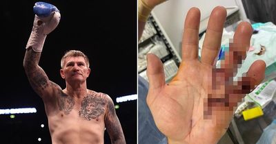 Boxing legend Ricky Hatton shows off scars after contracting rare disease