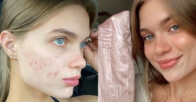 Beauty fans say 'magic' pillowcase clears up bad skin and painful acne in WEEKS