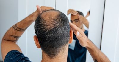 Balding process could be slowed as doctor lists five 'remedies' for hair loss