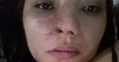Woman forced to wear mask after dentist disfigures her face in botched illegal nose job