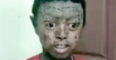 Boy, 12, suffers from rare condition leaving him with scaly skin like a snake