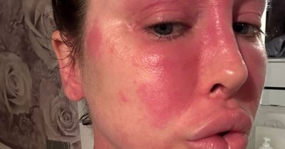 Ex On the Beach star on horror skin condition that has seen face 'swell and burn' - and left doctors baffled