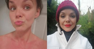 'I have a rare allergy to the cold weather - people have told me I look like a monster'