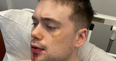 Man left with broken jaw after robbery in Dublin warns 'streets are not safe'