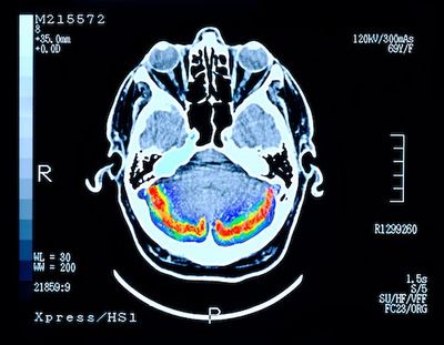 Viruses can speed up unhealthy brain aging — vaccines may offer peace of mind