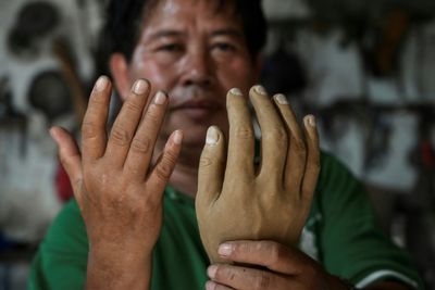 Indonesian leprosy survivor crafts new limbs for shunned villagers