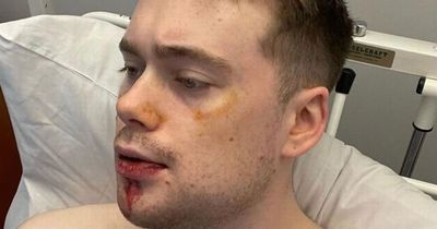 Man left with broken jaw after thugs rob phone says 'Dublin is not a safe place'