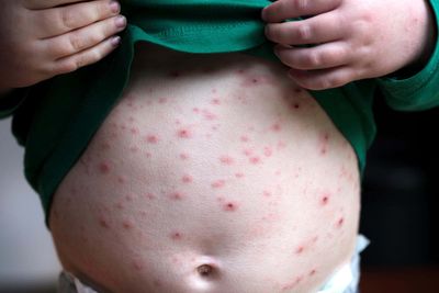 Introducing routine chickenpox jabs for children ‘could end risky pox parties’