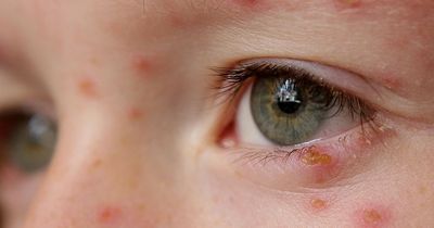 Most parents would support jabs for chickenpox during childhood