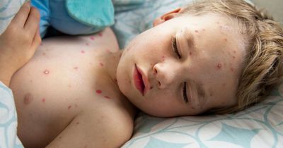 Majority of parents would accept routine NHS chickenpox jabs for children if they were introduced