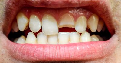 Man repairs broken tooth with plastic and superglue after failing to get NHS dentist