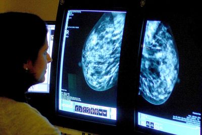 Health minister to consider ‘black box’ warnings of cancer link to breast implants