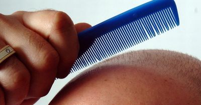 GP explains who to blame for going bald and it's not your mum