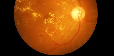 Macular diseases cause blindness and treatment costs millions. Here is how to look after yours