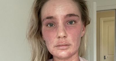 Woman no longer recognises herself after eczema cream 'burns' skin all over body