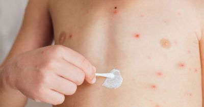 How to treat chickenpox at home and whether you can get a vaccine - dos and don'ts for parents