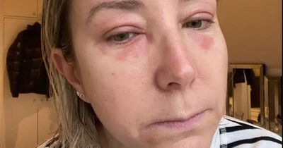 Eczema left fashion fan in tracksuits at home - until she discovered new over-the-counter cream