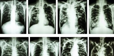 Rare genetic disease may protect Ashkenazi Jews against tuberculosis – new study