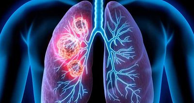 AI Can Improve Lung Nodule Detection In Chest X-Rays: Study