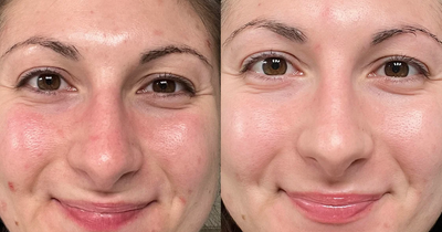 Shoppers ‘obsessed’ with ‘game changing’ toner that eased acne within two weeks