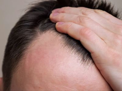 Payout for man, 61, targeted in office cull of bald men – despite full head of hair