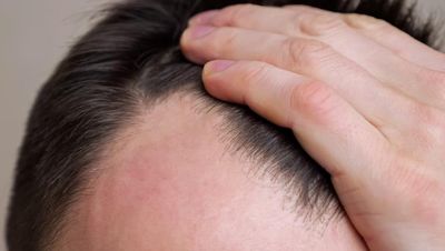 Payout for man (61) targeted in office cull of bald men – despite full head of hair