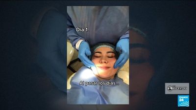 Doctors concerned about TikTok-viral 'cheek removal' surgeries