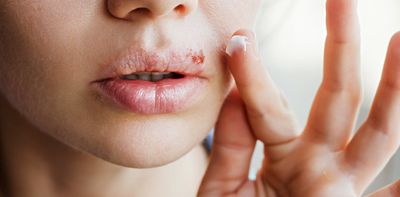 Crusty, blistering and peeling: where do cold sores come from and what can you do about them?