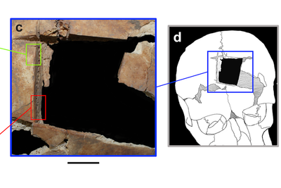 Earliest evidence of ‘uncommon’ type of brain surgery found in Israel