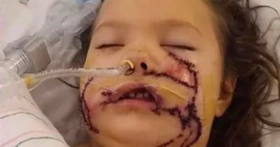 Girl, 6, attacked by dog has more than 1,000 stitches on her face after brutal injuries