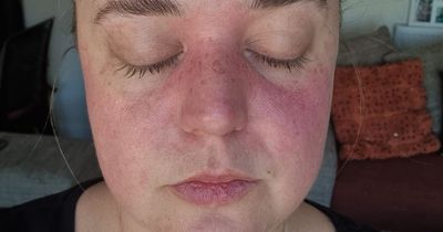 Woman diagnosed with rare brain condition which caused eyes to "switch off"