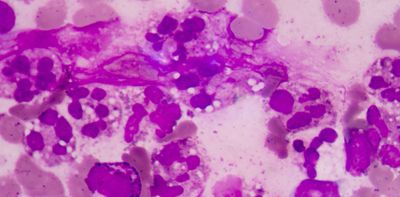 Genomics has helped identify a new strep A strain in Australia – and what has made it dangerous