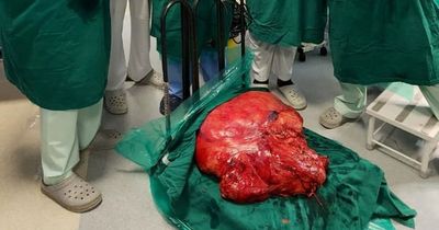 Doctors find 30kg tumour after man comes to hospital with pain in his stomach