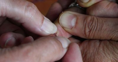 Rare and painful skin condition caught from cats seen in UK for first time